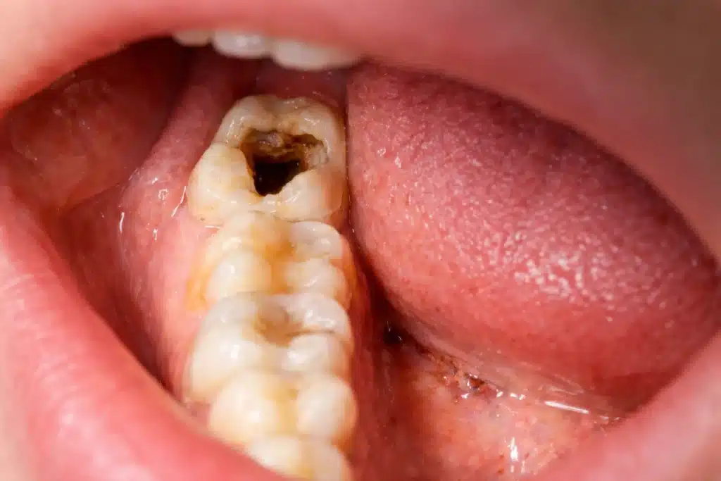 common dental problems
