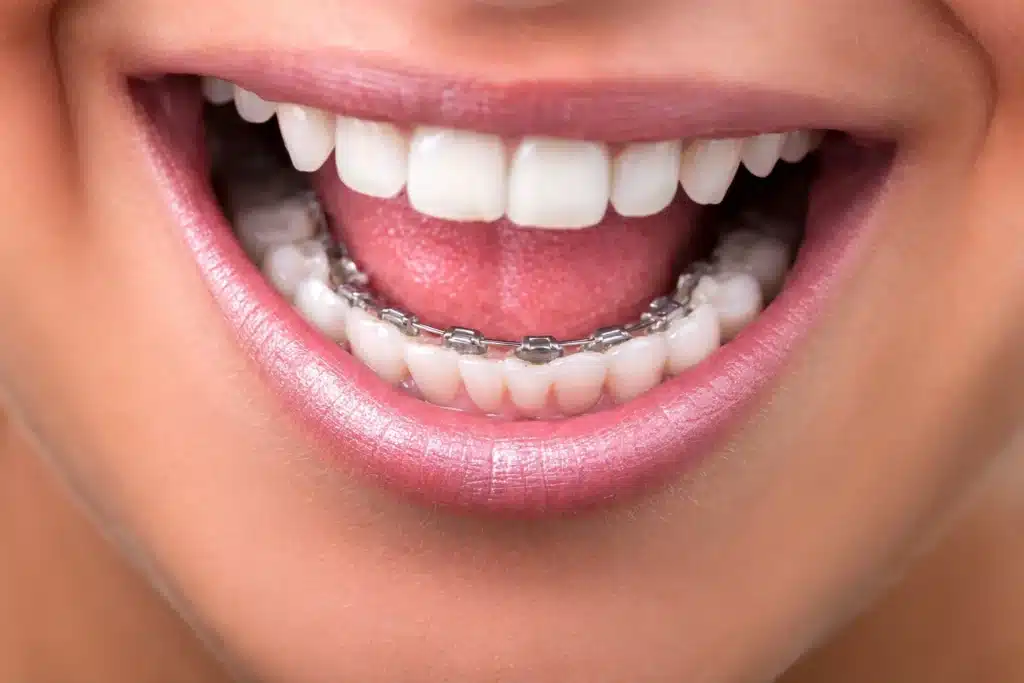 braces