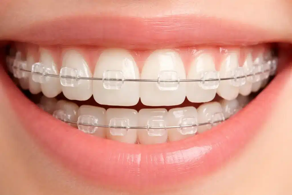 braces
