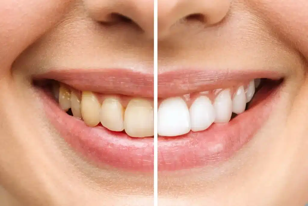 Why International Patients Choose Kerala for Dental Treatments