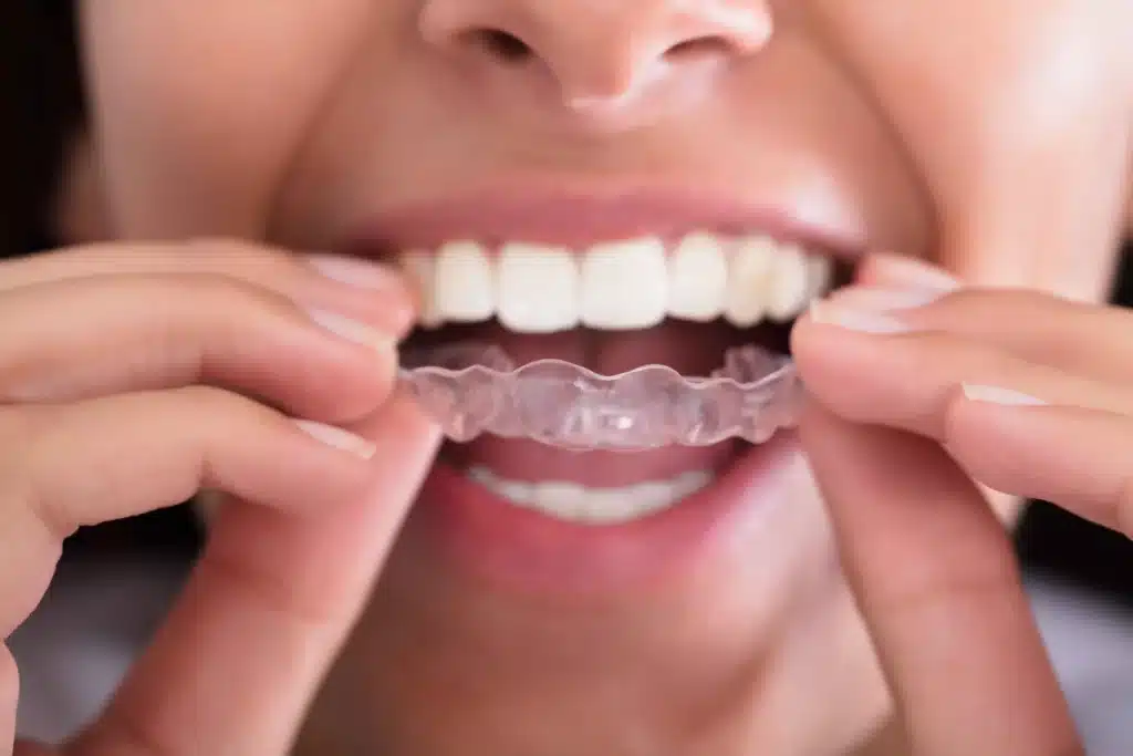 Are Invisible Aligners Safe