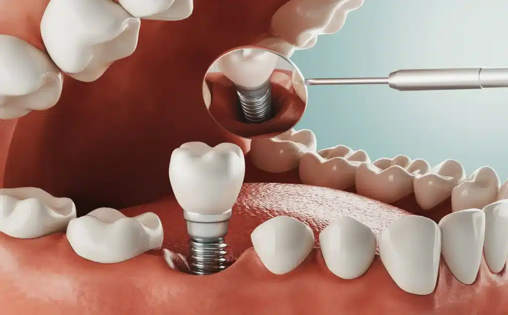 dental implants in Thalassery