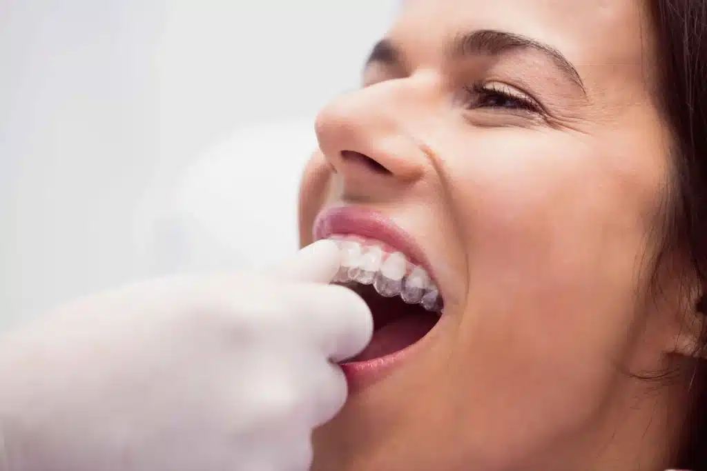 Invisible Aligners